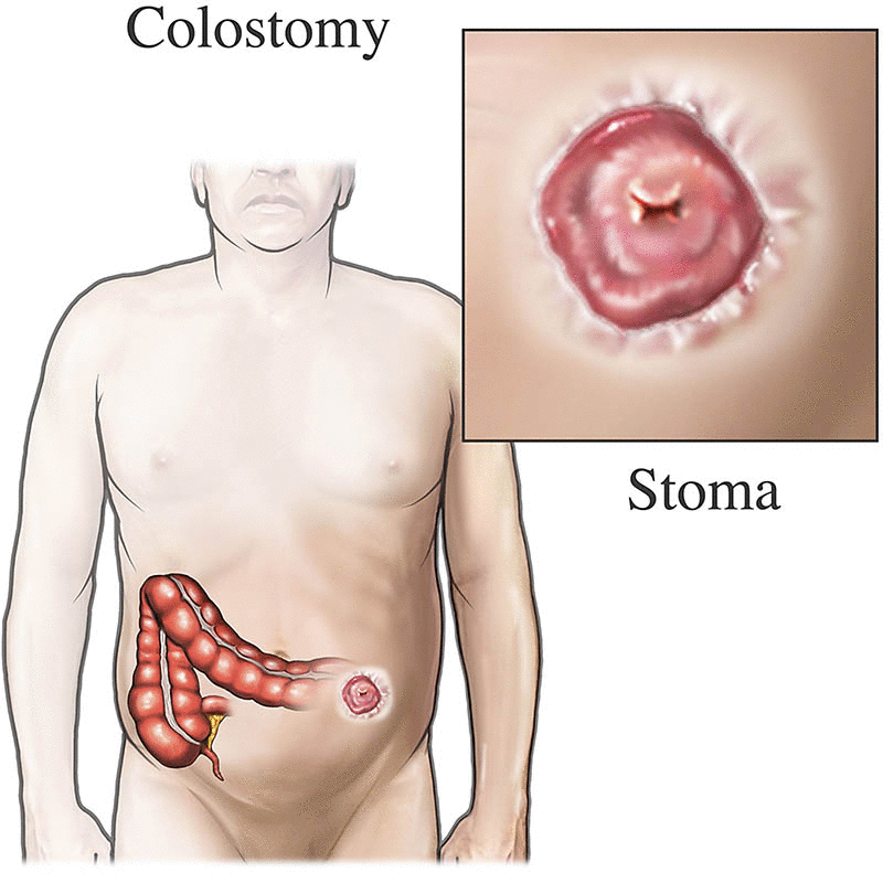 <p>A surgical opening of a portion of the colon onto the abdominal surface (stoma) allowing stool elimination into a collection pouch.</p>
