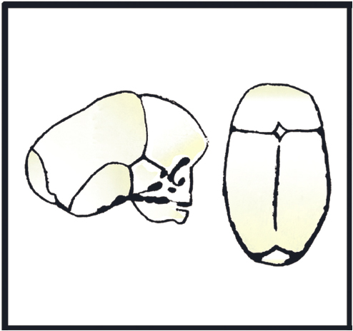 <p>17. What does the drawing in Figure 24-40 represent?</p><p>Figure 24-40</p><p>a. Dolichocephaly</p><p>b. Cloverleaf skull</p><p>c. Brachycephaly</p><p>d. Microcephaly</p>