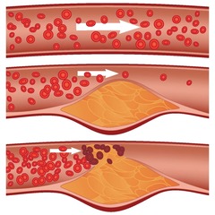 <p>arteriosclerotic heart disease</p>