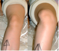 <p>lateral patellar deviation during terminal knee extension</p>