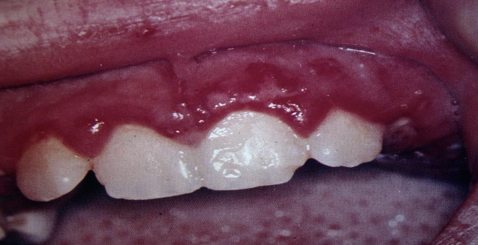 <p>what is this lesion and what is it associated with</p>
