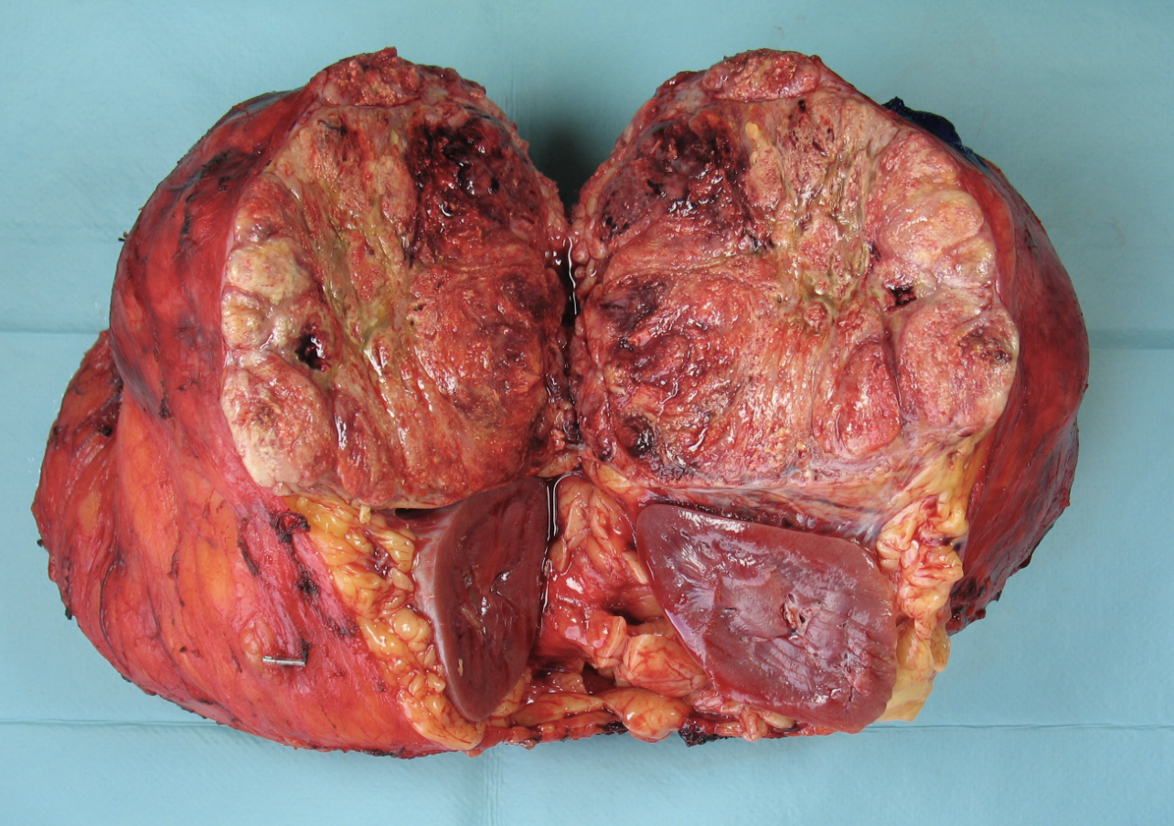 <p>Carcinome cortico surrénalien</p><p>1) Clinique importante </p><p>2) aspect morphologique </p><p>3) variantes morphologiques </p><p>4) Scores adénome vs carcinome </p>