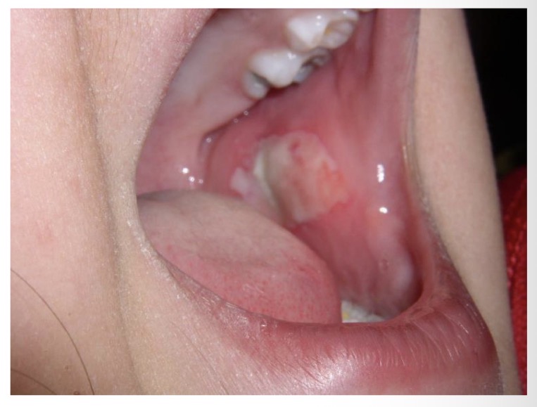 <p>BN CÓ VẾT LOÉT NHƯ HÌNH </p><p>CHẨN ĐOÁN</p>