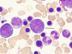 <p>14-24 um</p><p>N:C ratio 8:1</p><p>Royal blue cytoplasm. Fine chromatin</p><p>1-2 nucleoli</p><p>Normally confined to bone marrow.</p>
