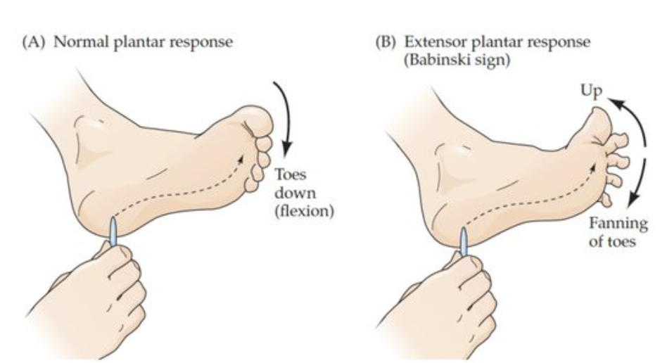<p>Damage to corticospinal descending pathways causes extensor plantar response. </p><ul><li><p>indicates incomplete upper MN control of spinal motor circuitry and a clinical sign of corticospinal lesion. </p></li></ul><p></p>