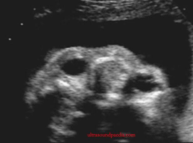 <p>abnormally wide interocular distance </p><ul><li><p>associated with</p><ul><li><p>trisomy 18 </p></li><li><p>noonan </p></li><li><p>medial cleft </p></li><li><p>anterior cephalocele</p></li></ul></li></ul><p></p>