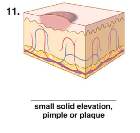 <p>small solid elevation, pimple or plaque</p>