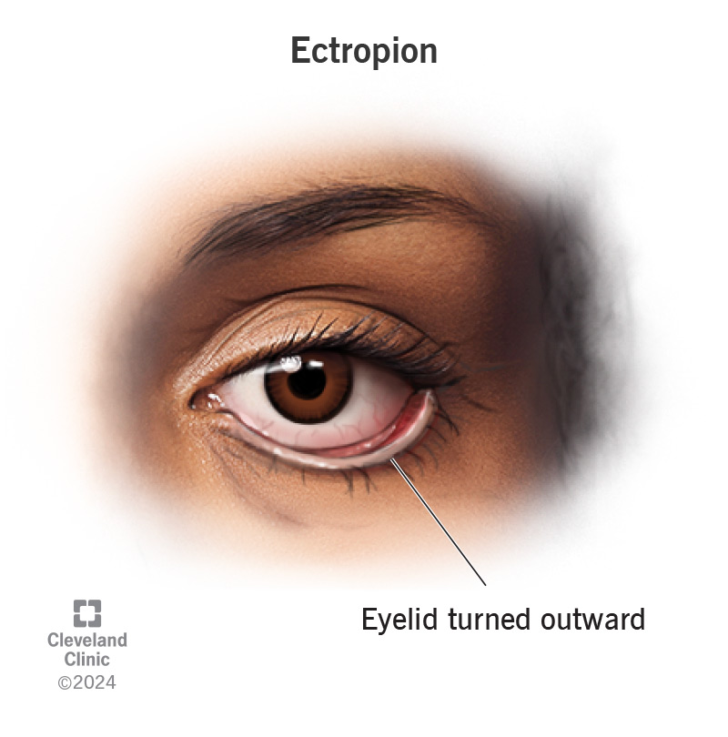 <p>eyelid turned outward</p>