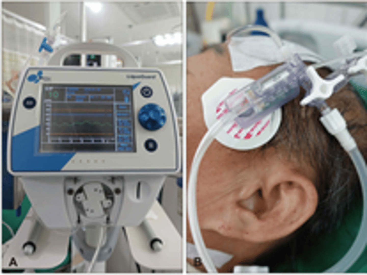 <p>small catheter connects sensor in epidural space to transducer that measures pressure within brain</p>