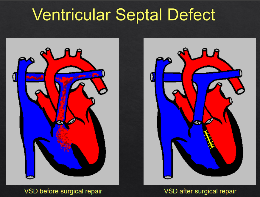 <p>Simple Acyanotic CHD</p><p><strong>RF</strong>: CHD</p><p><strong>Sx</strong>: Cough, noisy breathing/breathing difficulties, swelling/oedema, failure to thrive/LOW, short stature, crying/irritable/unwell, dysmorphic features, newborn resp. distress</p><p><strong><u>Ix</u></strong>:</p><p><strong>First Line</strong>: Clinical Exam (pansystolic murmur), CXR (cardiomegaly, overload)</p><p><strong>Gold Standard</strong>: Echocardiogram (size, location etc)</p><p></p>