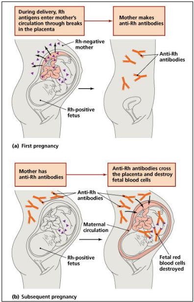 <p>ALLO-IMMUNE HAEMOLYTIC ANAEMIA:</p><p>- Transplacental passage of maternal RBC antibodies that bind to fetal RBC</p><p>- Maternal antibodies destroy fetal RBC</p><p>.</p><p>Usually Rh(D) negative mother and Rh(D) positive fetus</p><p>- Anti-D made by mother in 1st pregnancy when exposed to D antigen</p><p>- Subsequent pregnancy affected</p><p>- Maternal anti-D crosses the placenta</p><p>- Anti-D binds to and destroys fetal Rh(D)-positive RBC</p><p>.</p><p>- D represnts a specific blood type. basically it menas that the mother naturally has anti something (e.g Anti A). If the fetus is A, then these Anti A travel through placenta and destory fetal blood cells</p>
