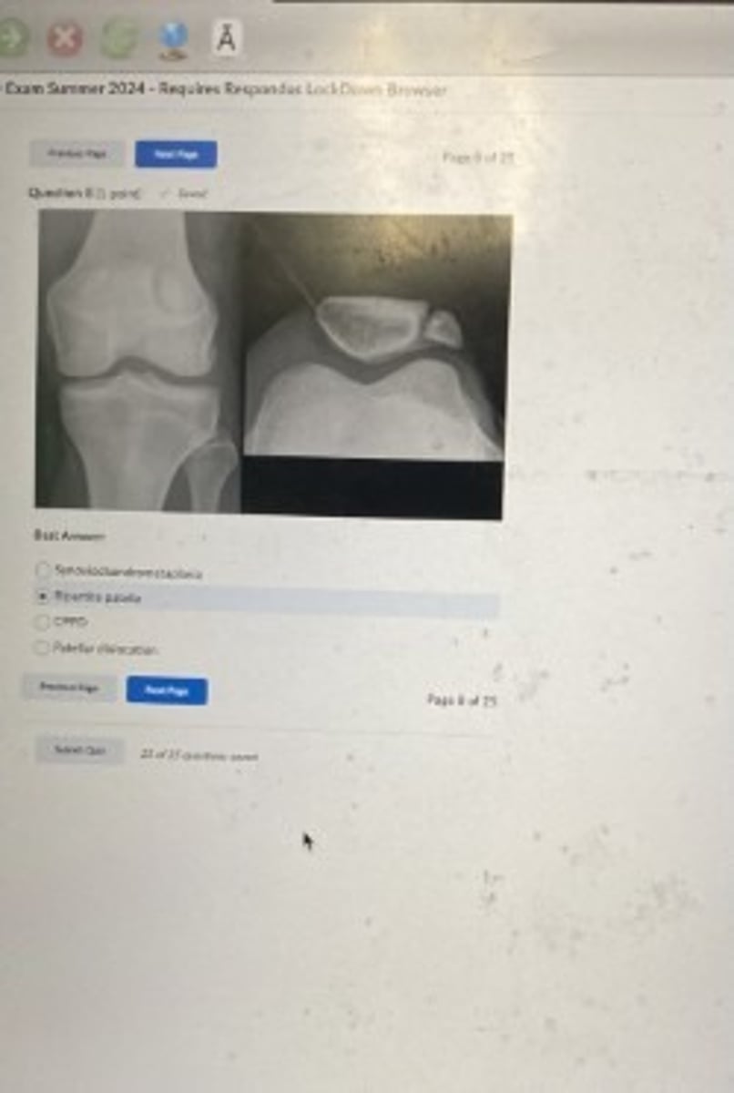 <p>Bipartite patella</p>