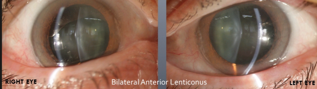 <p>Alport syndrome an -linked mutation in COL4A5 , usually hematuria is first sign to notice then ESRD along with sensoneuronal hearing loss and lens: anterior lenticonus and corneal opacities(bm in cornea)</p>
