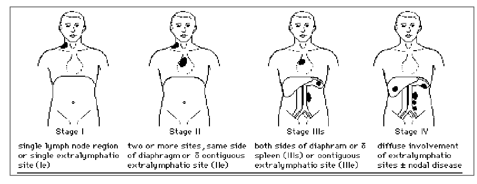 <p>- Extent of disease; determines therapy and prognosis</p><p>- Based on physical, radiologic examination, BM</p><p>- B symptoms: fever, weight loss > 10%, night sweats</p>