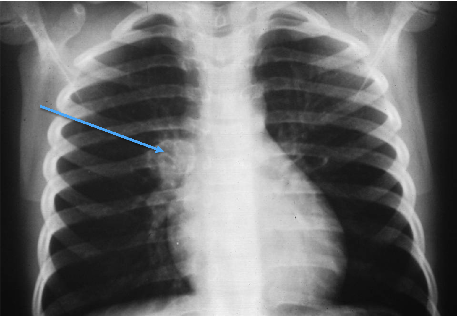 <p>What tumour-like condition is this, what bone is it in and what can be seen?</p>