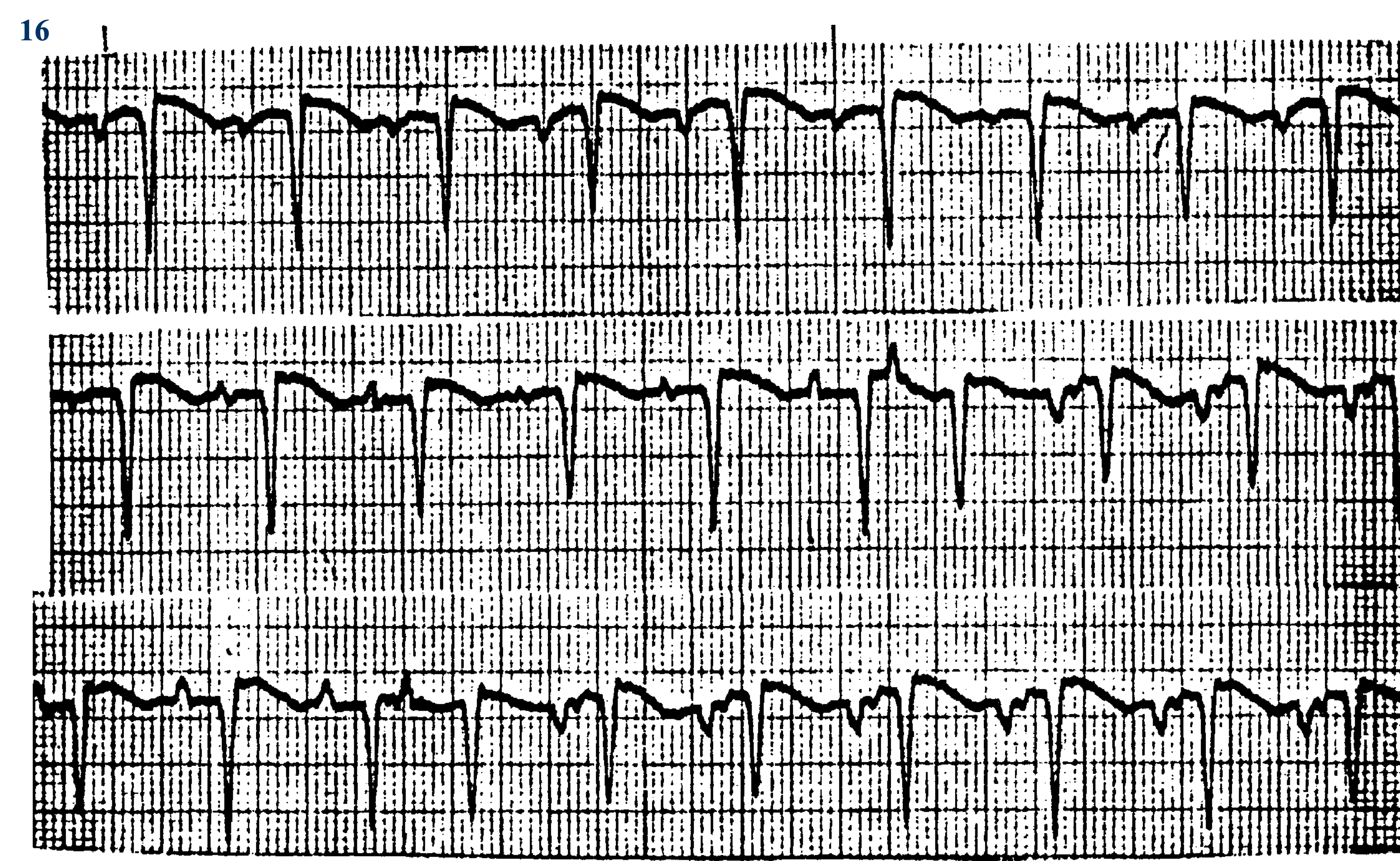 <p>What ECG is this</p>