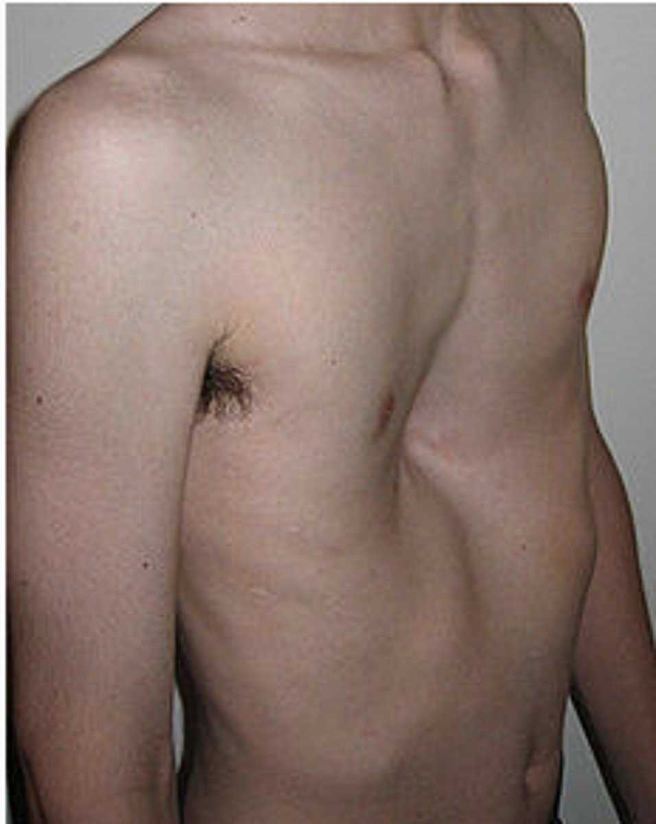 <p>a chest that is hollowed out/funnel chest; congenital</p>