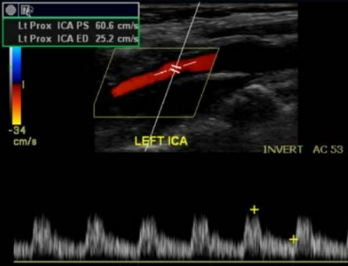 <p>Speed and direction of blood flow</p>