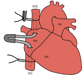 <p>Two single-stage cannulae sit in the inferior and superior vena cavae and are connected using a Y-connected to the venous line </p>