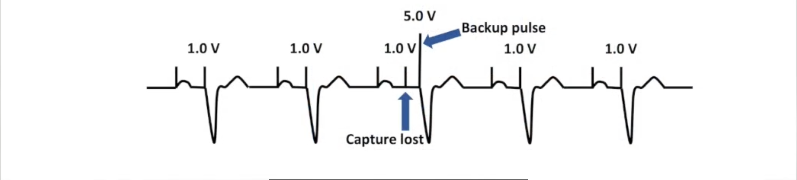 <ul><li><p>Device constantly monitors evoked response</p></li><li><p>Beat to beat or rolling window</p></li><li><p>Capture lost: high output backup pulse</p></li><li><p>Runs another threshold test after certain # of beats</p></li></ul><p></p>