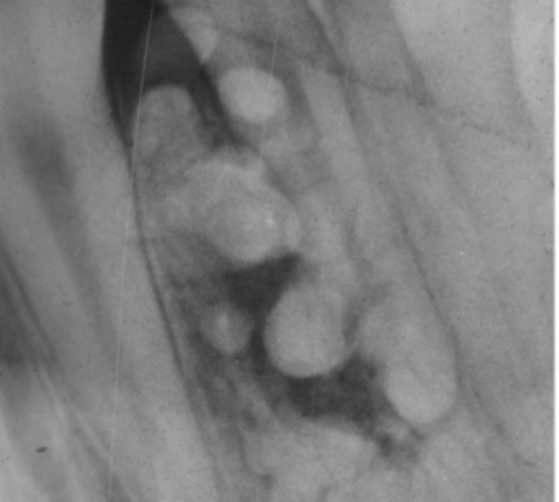 <p>which feature favors a compound over complex odontoma </p>