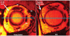 <p>a bilateral divergence insufficiency esotropia greater at distance (12 PD) than near (5 PD) typically in patients >70 yo due to degeneration of connective tissue and sagging of the lateral rectus. A small vertical deviation and bilateral blepharoptosis are also common.</p>