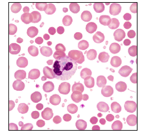 <p>- Burns: small, contracted red blood cells</p><p>- Heat-damage to the red blood cell membrane</p>