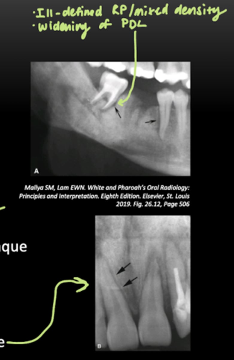 <p>- sun ray periosteal reaction</p><p>- low-grade lesions appear more benign</p><p>- asymmetric, irregular widening of the PDL space</p>
