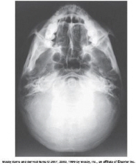 <p>CR angle and line</p>