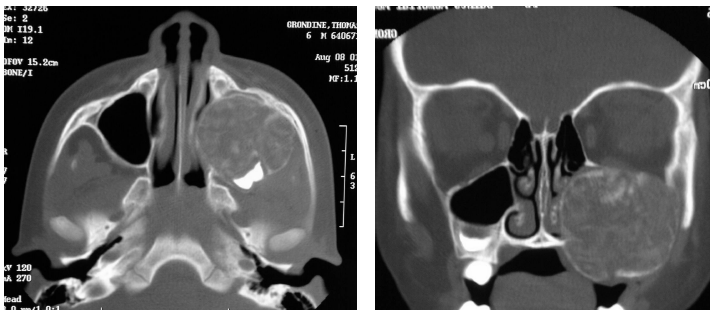 <p>juvenile ossifying fibroma</p>