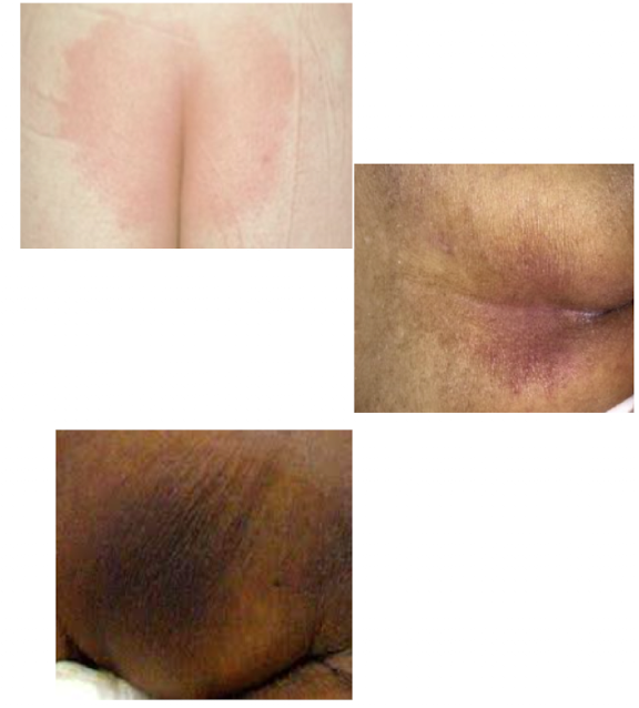 <p>Intact skin with localized non-blanchable erythema + darker/red</p>