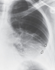 <p>This x-ray image indicates what pathology?</p>