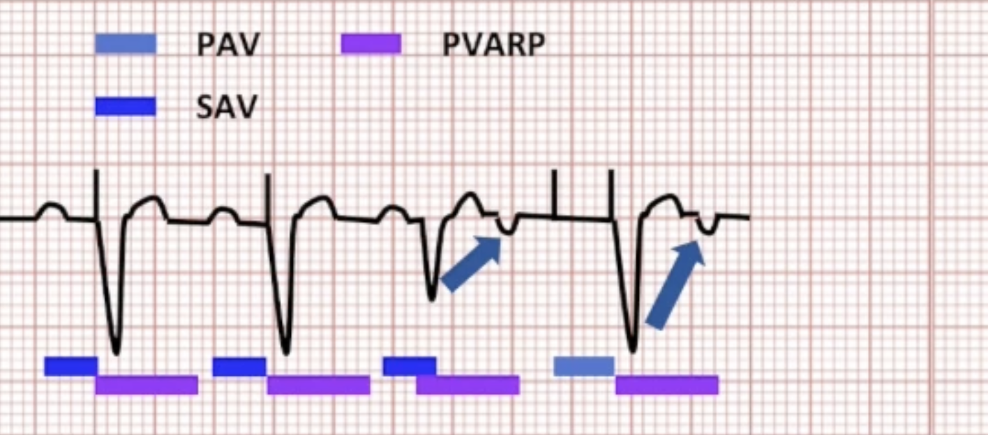 <ul><li><p>No intrinsic conduction: AV delay times out</p></li><li><p>V pacing causes retrograde conduction again: FUS</p></li></ul><p></p>