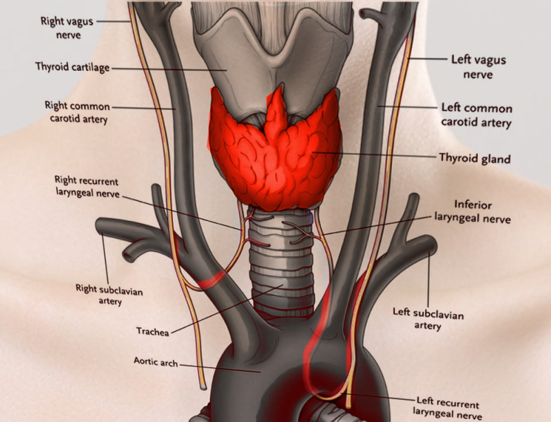 <p>Bilateral vocal cord paralysis → STRIDOR + AIRWAY OBSTRUCTION</p><p>(may require urgent intubation/tracheostomy).</p>