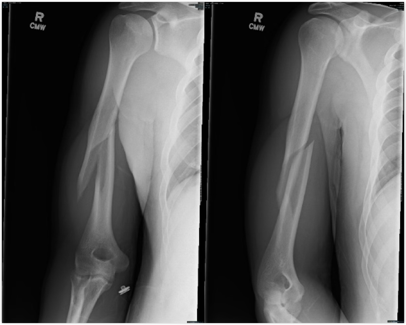 <p>symptoms of a humeral fracture</p>