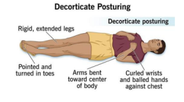 <ul><li><p>flexed, indicates damage to the cerebral cortex</p></li><li><p>indicates severe brain damage </p></li></ul><p></p>