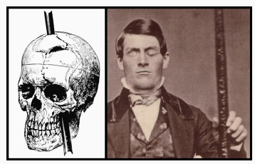 <ul><li><p>Overleefde een ernstig ongeval waarbij een metalen staaf zijn hoofd doorboorde via zijn wang en rechter slaap</p></li><li><p>Doormaakte <strong>persoonlijkheidsverandering</strong>: werd impusliever, prikkelbaar en zeer onbetrouwbaar<br>→ demonstratie van connectie tussen…</p><ul><li><p>hersengebieden en cognitieve functies</p></li><li><p>frontale kwabben en persoonlijkheid/gedrag</p></li></ul></li></ul><p></p>