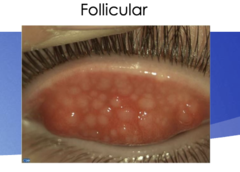<p>-best view in upper tarsus</p><p>-rounded, avascular white or grey structure</p><p>-seen more in viral conjunctivitis, chlamydia</p>