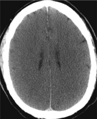 <p>- compression or obliteration of the normal sulci</p><p>- ventricles may be compressed</p>