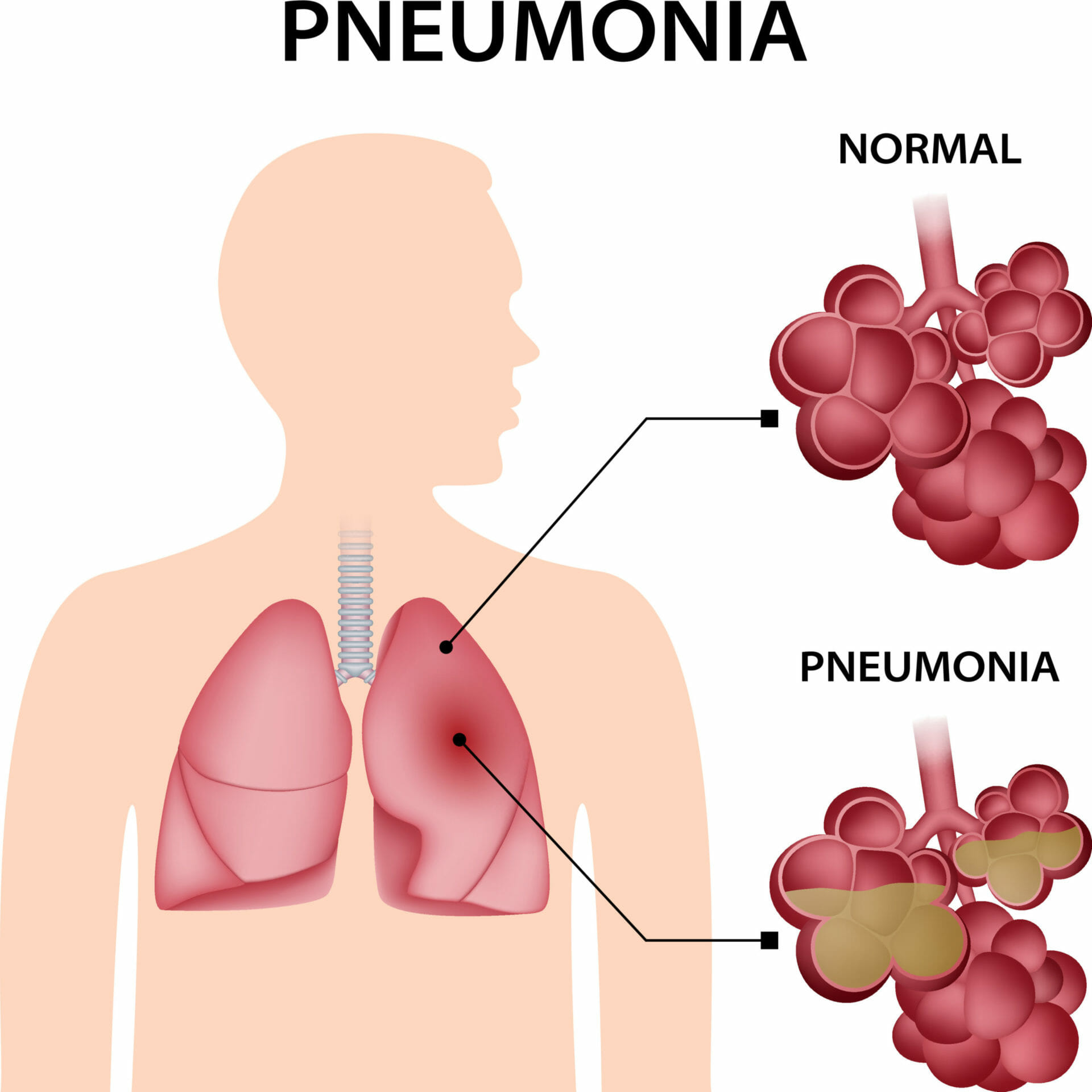<p>An <strong>infection of the lungs</strong> that causes the <strong>air sacs to fill with fluid or pus</strong>, making breathing difficult.</p>