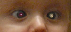 <p>white pupillary reflex is concerning for</p>