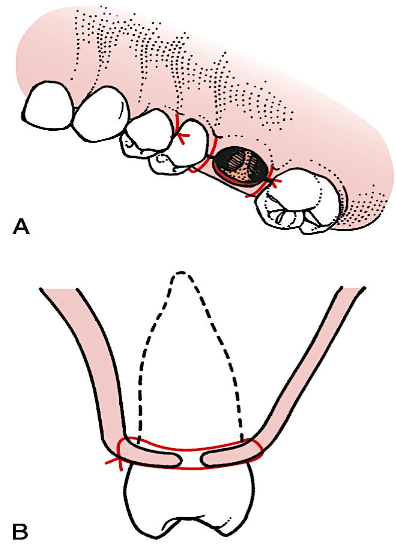 <p>sutures are <span style="color: red;">placed at the papillae</span> only, <span style="color: red;">not </span>placed at <span style="color: red;">empty tooth </span><span style="color: red;">socket</span></p>