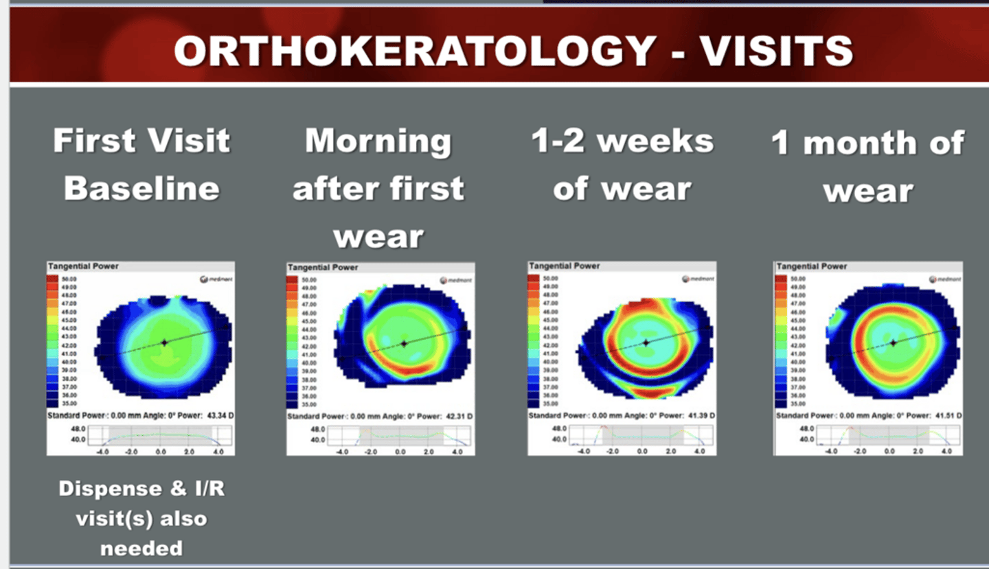 <p>When do you typically need to see patients back for OrthoK F/U visits?</p>