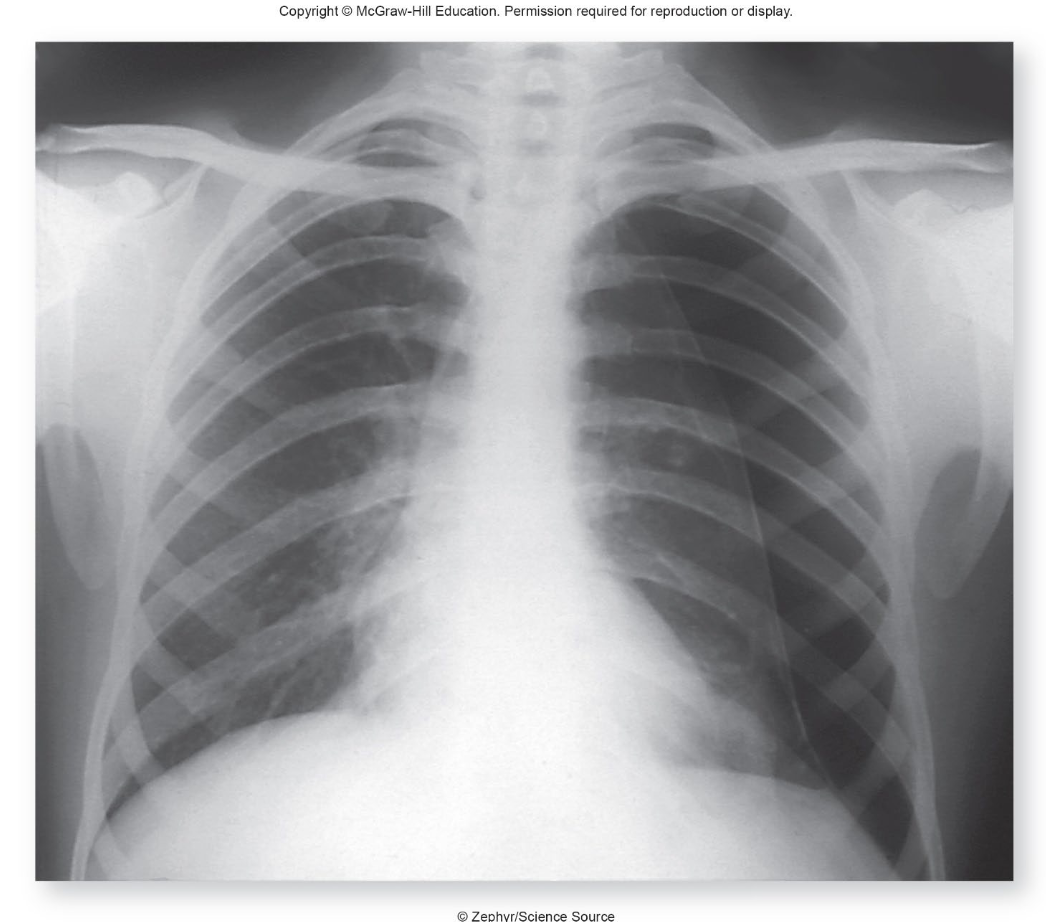 <p>a condition where air enters the pleural space, leading to lung collapse due to pressure imbalance. It can be caused by trauma, disease, or spontaneously. when looking at imaging the collapsed side with be darker due to more air in the lungs </p>
