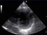 <p>FOV: sector</p><p>Used for cardiac</p>