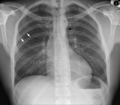 <p>CXR findings of coarctation of the aorta</p>