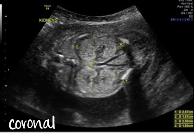 <p><span style="color: red;"><strong>transverse</strong></span> (easiest plane)</p><ul><li><p><span style="color: red;">kidneys visualized on either side of spine</span></p></li><li><p><span style="color: red;">measure AP diameter of renal pelvis</span></p></li></ul><p><strong>sagittal</strong></p><ul><li><p>long axis of kidney</p></li></ul><p><strong>coronal</strong></p><ul><li><p>demonstrates a longer axis image of both kidneys</p></li></ul><p>**always throw color Doppler on</p>