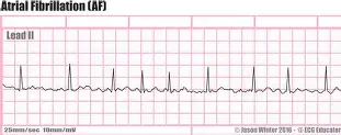 <p>atrial fibrillation</p>