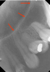 <p>nasal fossa</p>