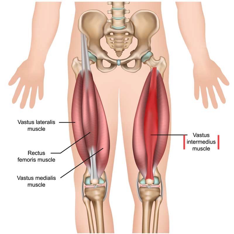 <p>Proximal Attachment (O): Anterior and lateral surfaces of shaft of femur</p><p>Distal Attachment (I): Via common tendinous (quadriceps tendon) and independent attachments to base of patella; indirectly via patellar ligament to tibial tuberosity; medial and lateral vasti also attach to tibia and patella via aponeuroses (medial and lateral patellar retinacula).</p><p>Nerve: Femoral nerve (L2, L3, L4)</p><p>Action: Extends knee joint; rectus femoris also steadies hip joint and helps iliopsoas flex hip joint.</p>